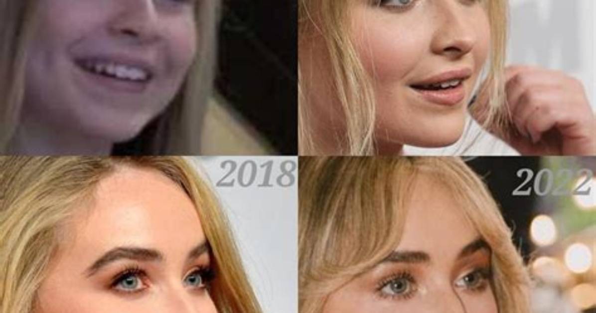 Analyzing Sabrina Carpenter's Lip Filler Rumors: Truth or Fiction?