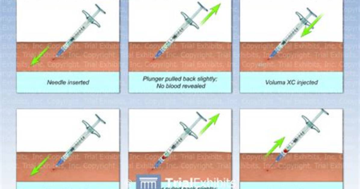 Aspirate Before Injection for Optimal Safety