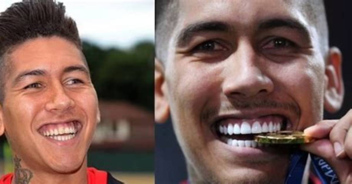 Before and After Photos of Roberto Firmino Teeth- Explore His New Looks