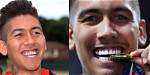 Before and After Photos of Roberto Firmino Teeth- Explore His New Looks