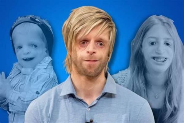 Courageous Faces: Celebrities with Treacher Collins Syndrome
