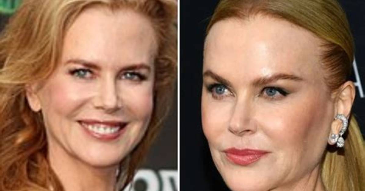 Enhance Your Beauty: Nicole Kidman's Transformative Rhinoplasty Journey