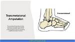 Essential Guide to Transmetatarsal Amputation: Recovery and Rehabilitation