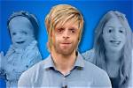 Famous Personalities Living with Treacher Collins Syndrome