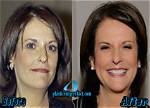 Gloria Borger's Facelift: Before and After Photos and Details
