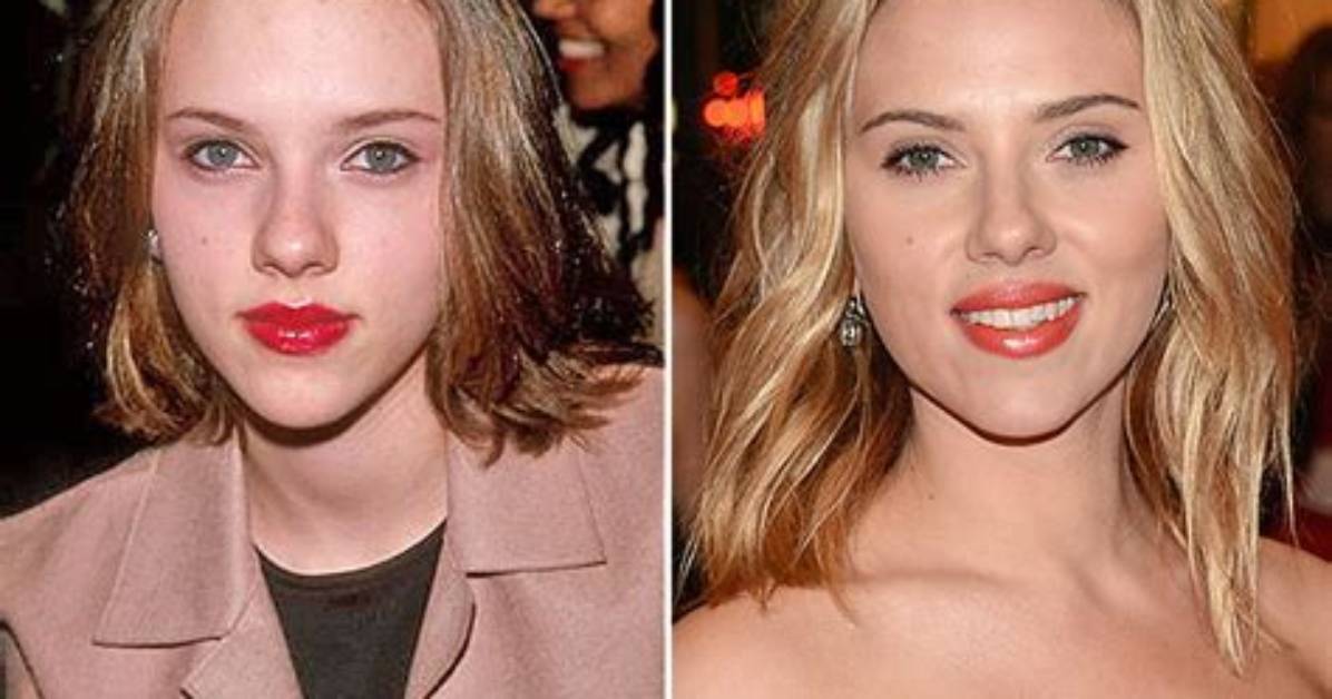 Has Scarlett Johansson Had Plastic Surgery? Truth Revealed Here