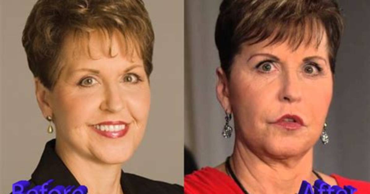 Joyce Meyer's Cosmetic Surgery Journey Revealed