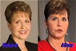 Joyce Meyer's Cosmetic Surgery Journey Revealed