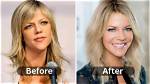 Kaitlin Olson Plastic Surgery as Dee from Always Sunny