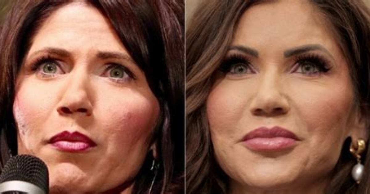 Kristi Noem's Alleged Plastic Surgery Journey