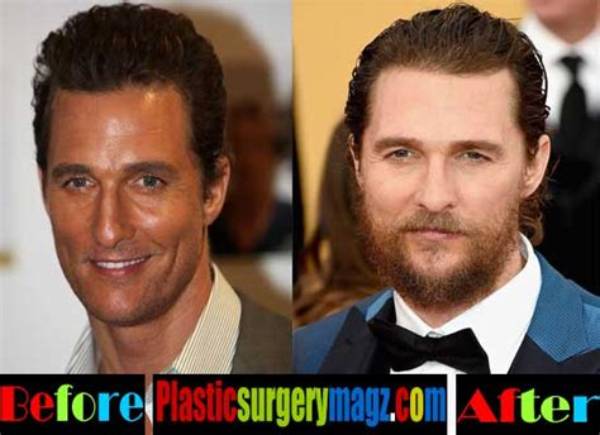 Matthew Mcconaughey's Guide to Plastic Surgery: Unlocking Youthful Beauty
