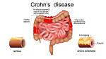 Mrbeast's Battle with Crohn's Disease Unveiled