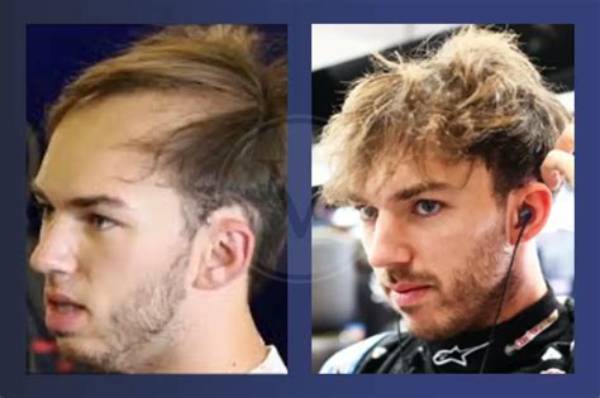 Pierre Gasly: the Evolution of His Hair and Style