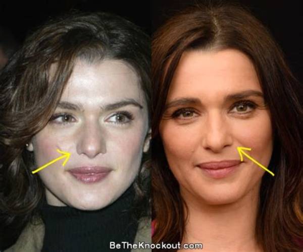 Rachel Weisz Plastic Surgery: Did She or Didn't She?
