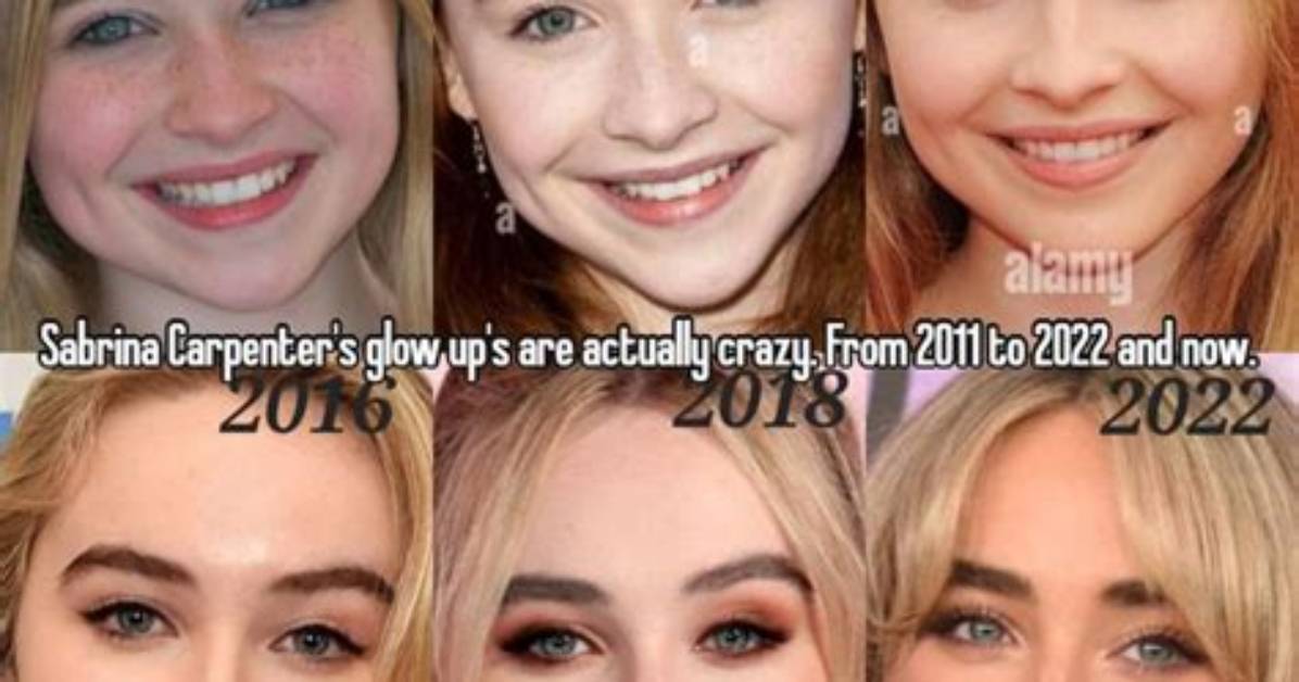 Sabrina Carpenter's Lip Filler Journey: a Candid Look at the Procedure