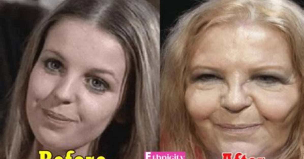 Sally Thomsett Face Surgery & Before After Pictures, Does She Also Have an Illness?