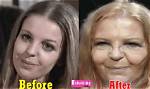 Sally Thomsett Face Surgery & Before After Pictures, Does She Also Have an Illness?