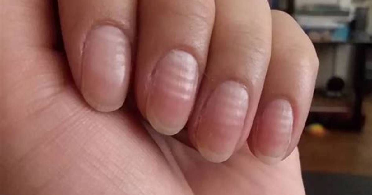 The Revealing Ridges on Fingernails