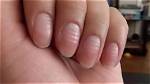 The Revealing Ridges on Fingernails