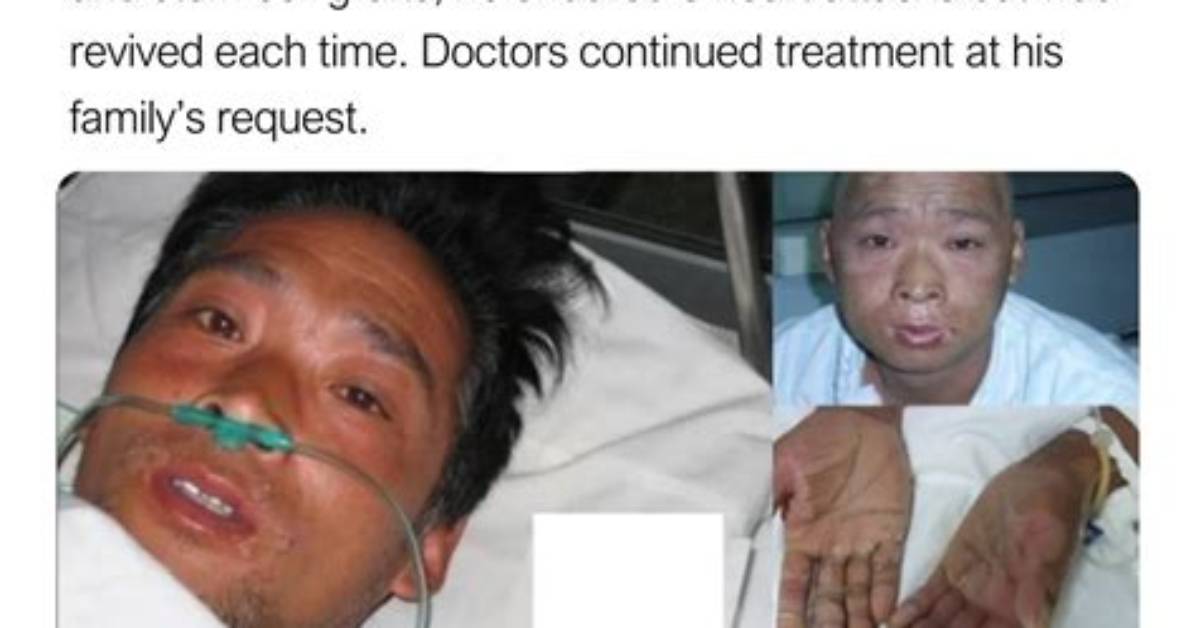 The Tragic Case of Hisashi Ouchi: a Deep Dive into His Injuries
