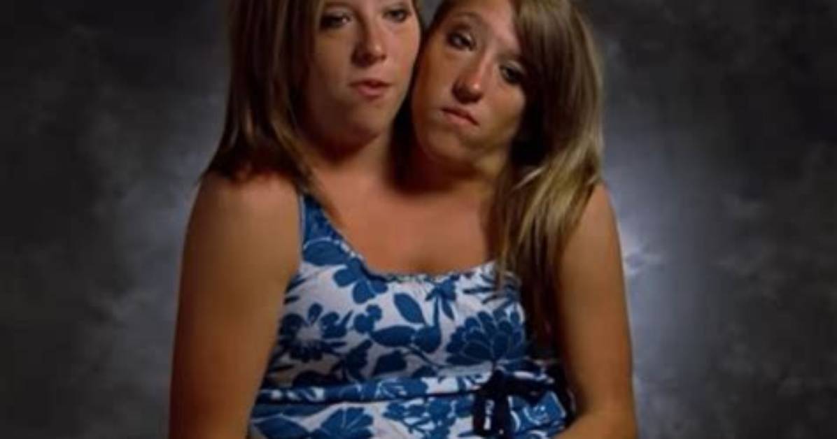 The Tragic Cause Behind the Hensel Twins' Untimely Death