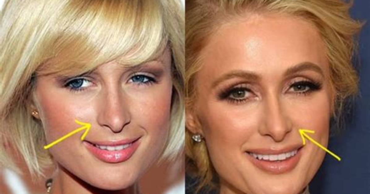 The Truth Behind Paris Hilton's Nose: Has She Had Surgery?