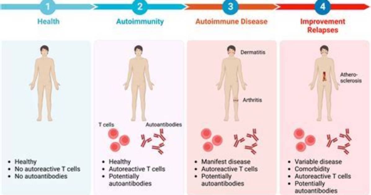 The Ultimate Guide to Radamm: Understanding and Treating This Autoimmune Disease