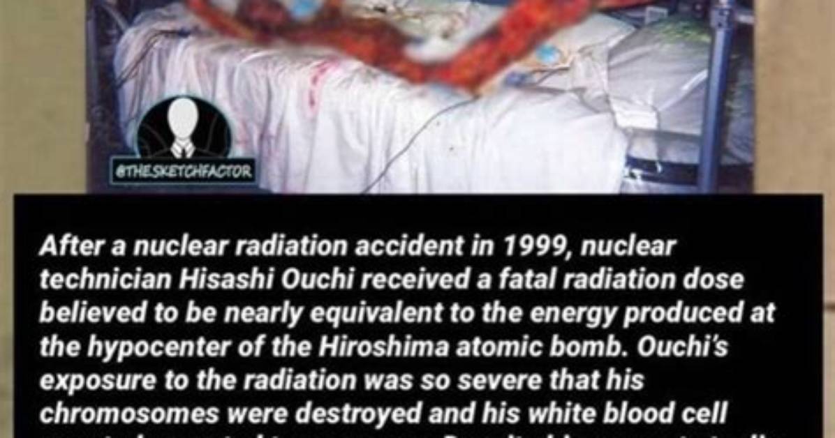 Tragedy of Hisashi Ouchi: Radiation Burns Aftermath