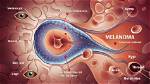 Understanding Melanoma: a Comprehensive Guide to Skin Cancer
