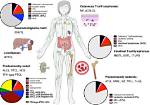 Understanding the Devastating Impact: Death from Lymphoma