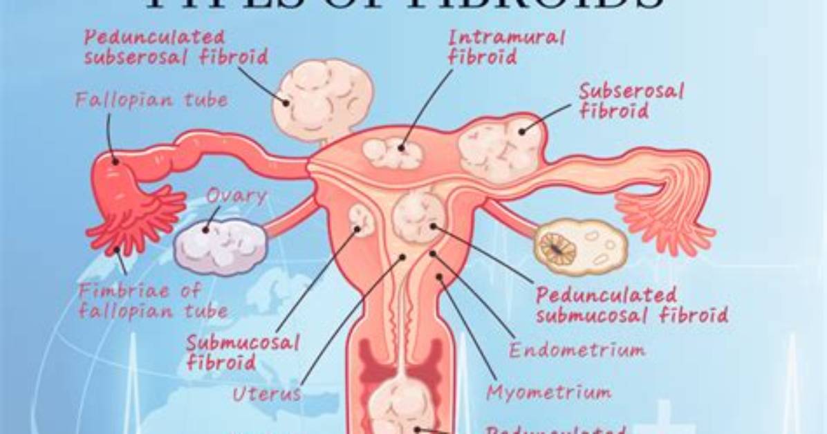 Understanding Uterine Fibroids in Relation to Brittney Griner: a Trans Perspective