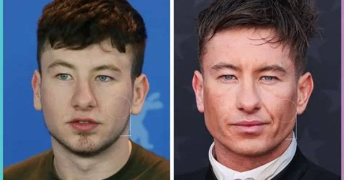 Unmasking Barry Keoghan's Eye Surgery: the Intriguing Details