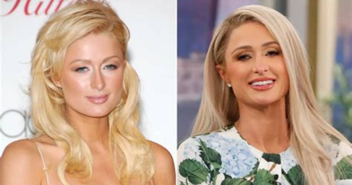 Unmasking the Truth: Did Paris Hilton Undergo Rhinoplasty?