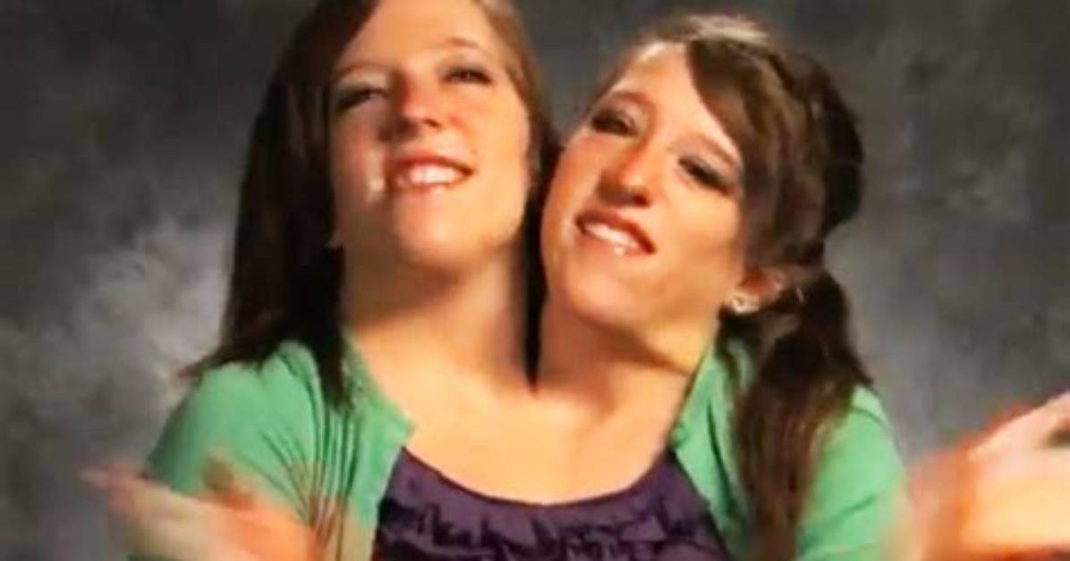 Unraveling the Mystery: Did the Hensel Twins Die?