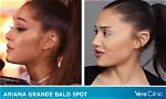 Unveiling Ariana Grande's Hair Loss Journey: Insights and Revelations