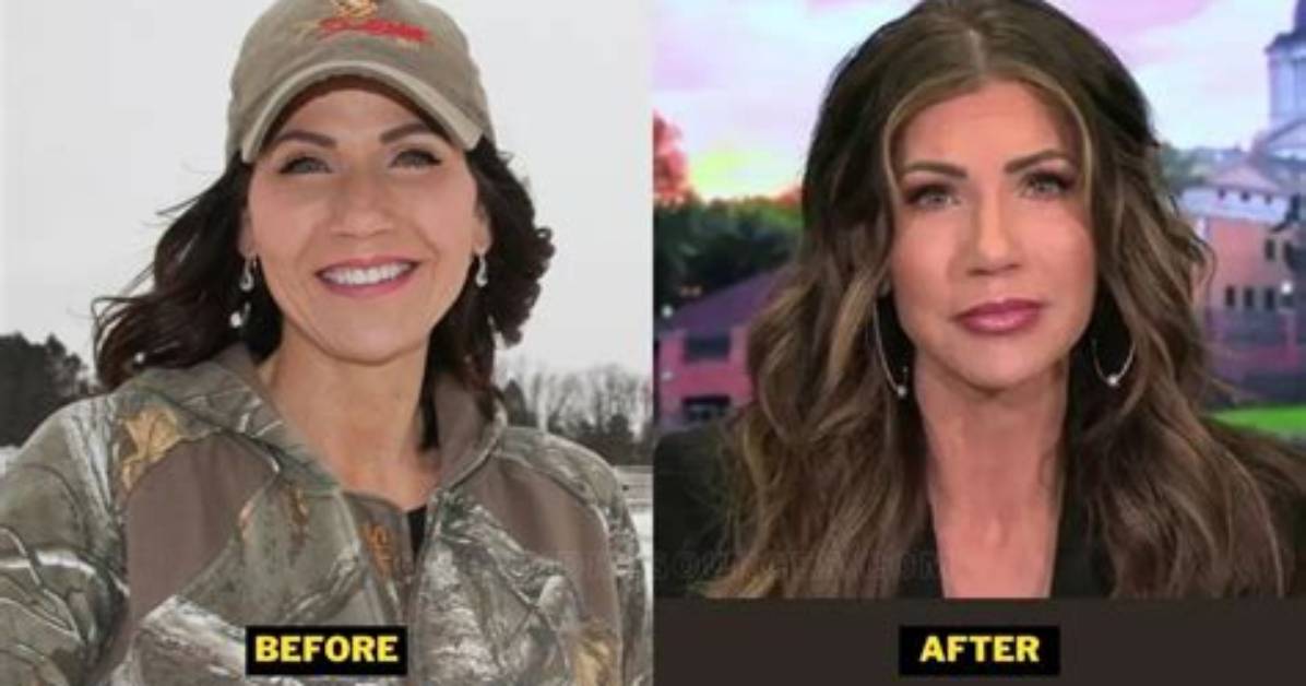 Unveiling Kristi Noem's Transformation: the Face Lift Phenomenon