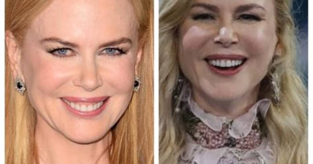 Unveiling the Truth Behind Nicole Kidman's Plastic Surgery Journey