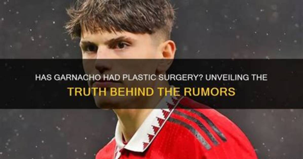 Unveiling the Truth: Garnacho Face Surgery