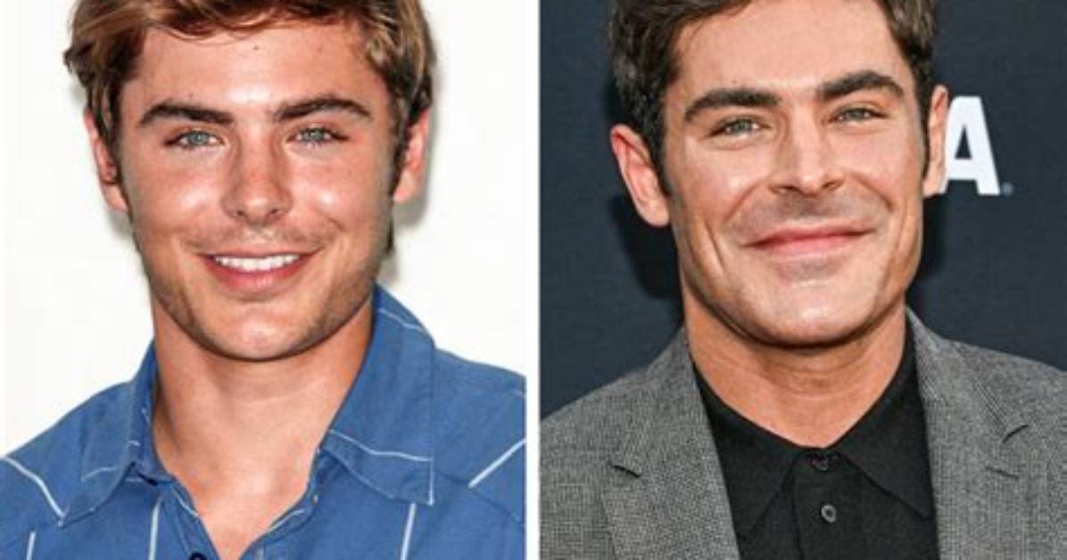 What Did Zac Efron Do to His Face? Injury or Plastic Surgery, Why Did His Face Change?