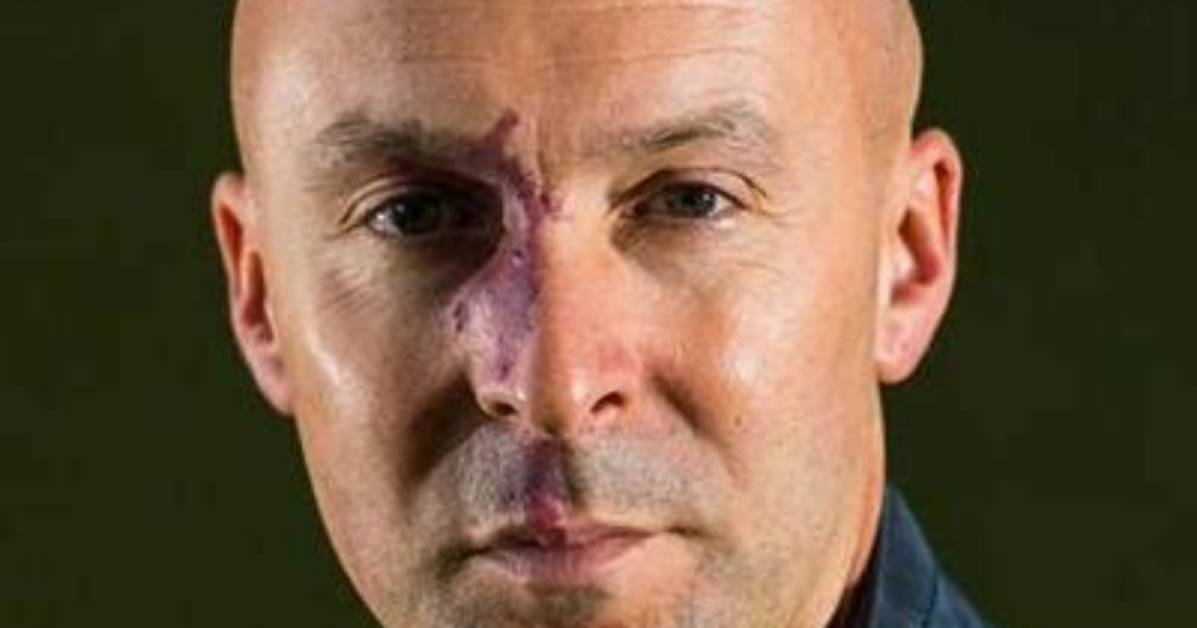 What Happened to Christopher Brookmyre Face? Is It His Birthmark or Some Other Scar?