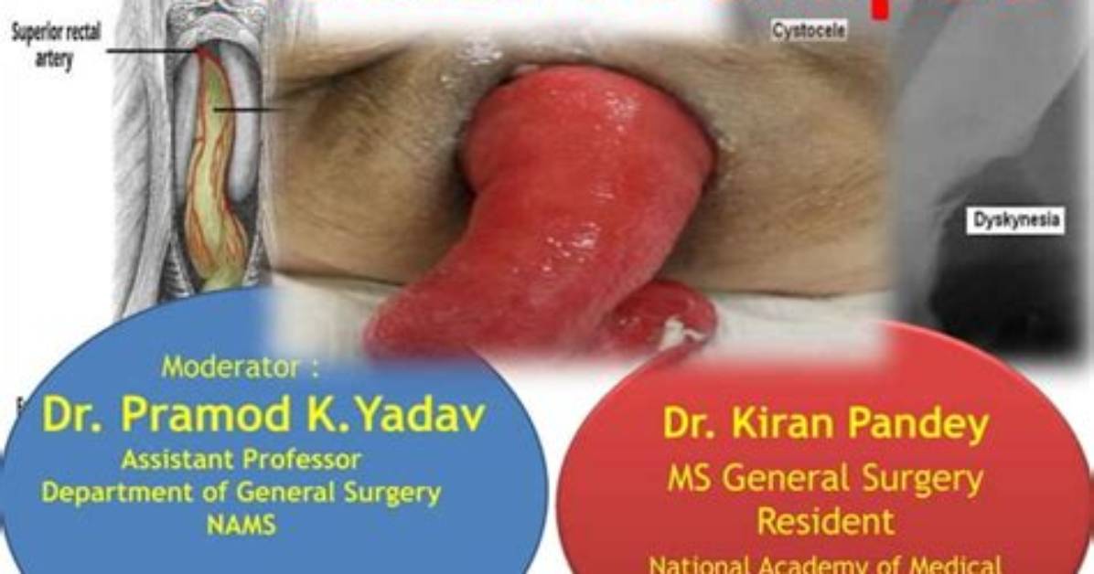 What Is Rectal Prolapse Surgery? Howie Mandel Deleted Tik Tok Video