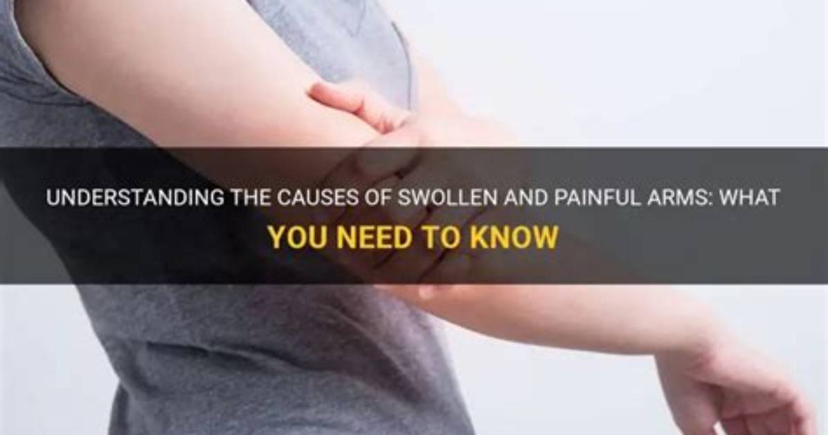 What You Need to Know About Swollen Virchow's Node Cancer