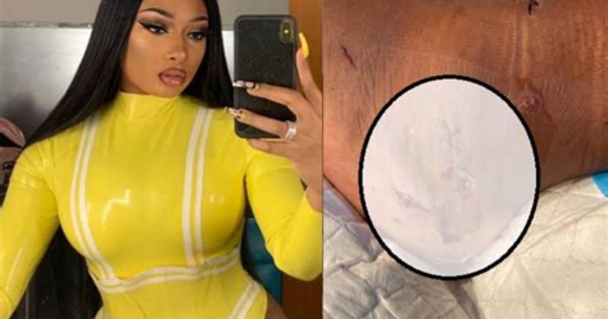 When Was Megan Thee Stallion Shot? Foot Injury Pictures Surface from Tory Lanez Trial